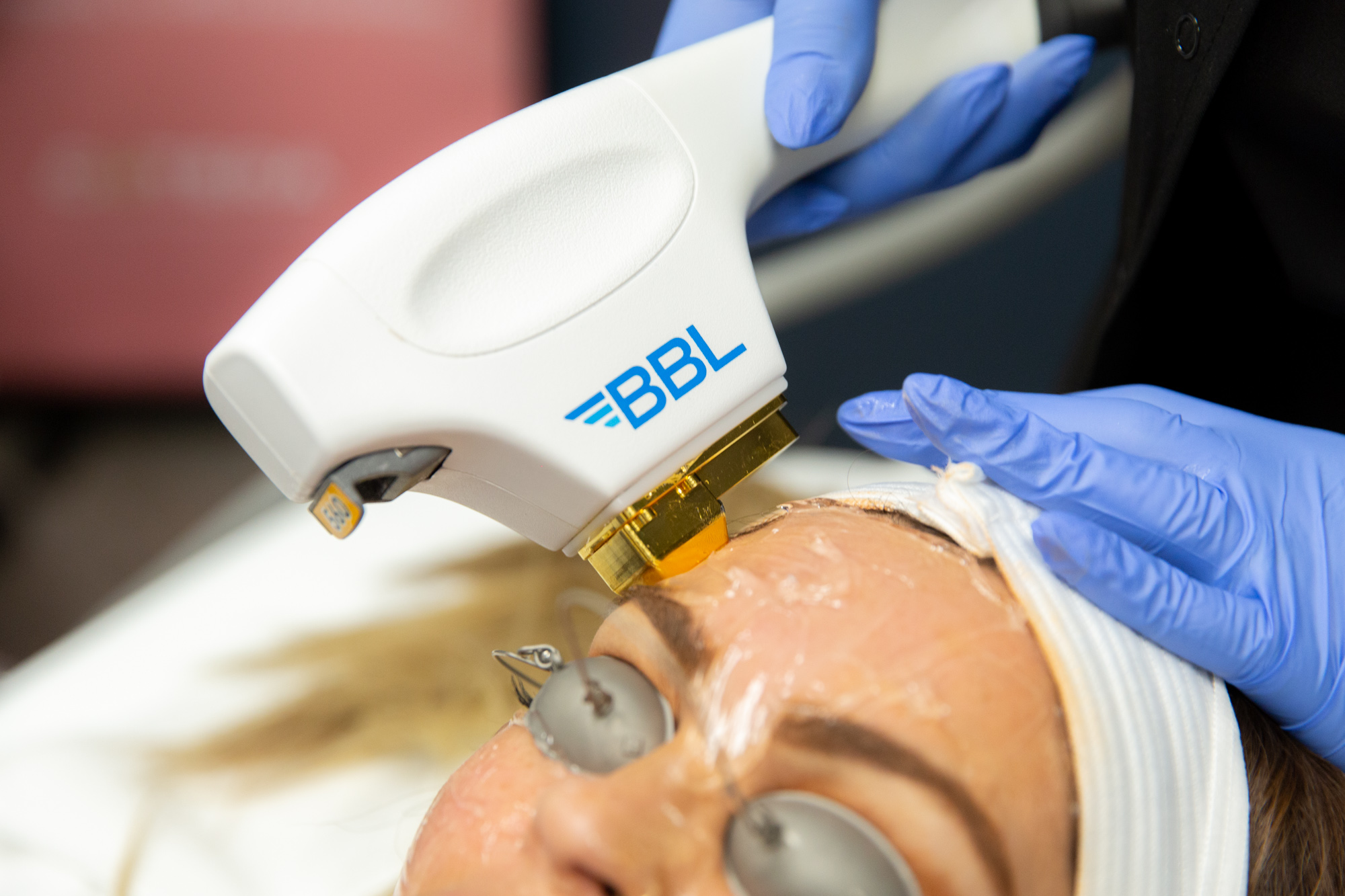 Close up of BBL Hero machine being applied to female client's forehead.