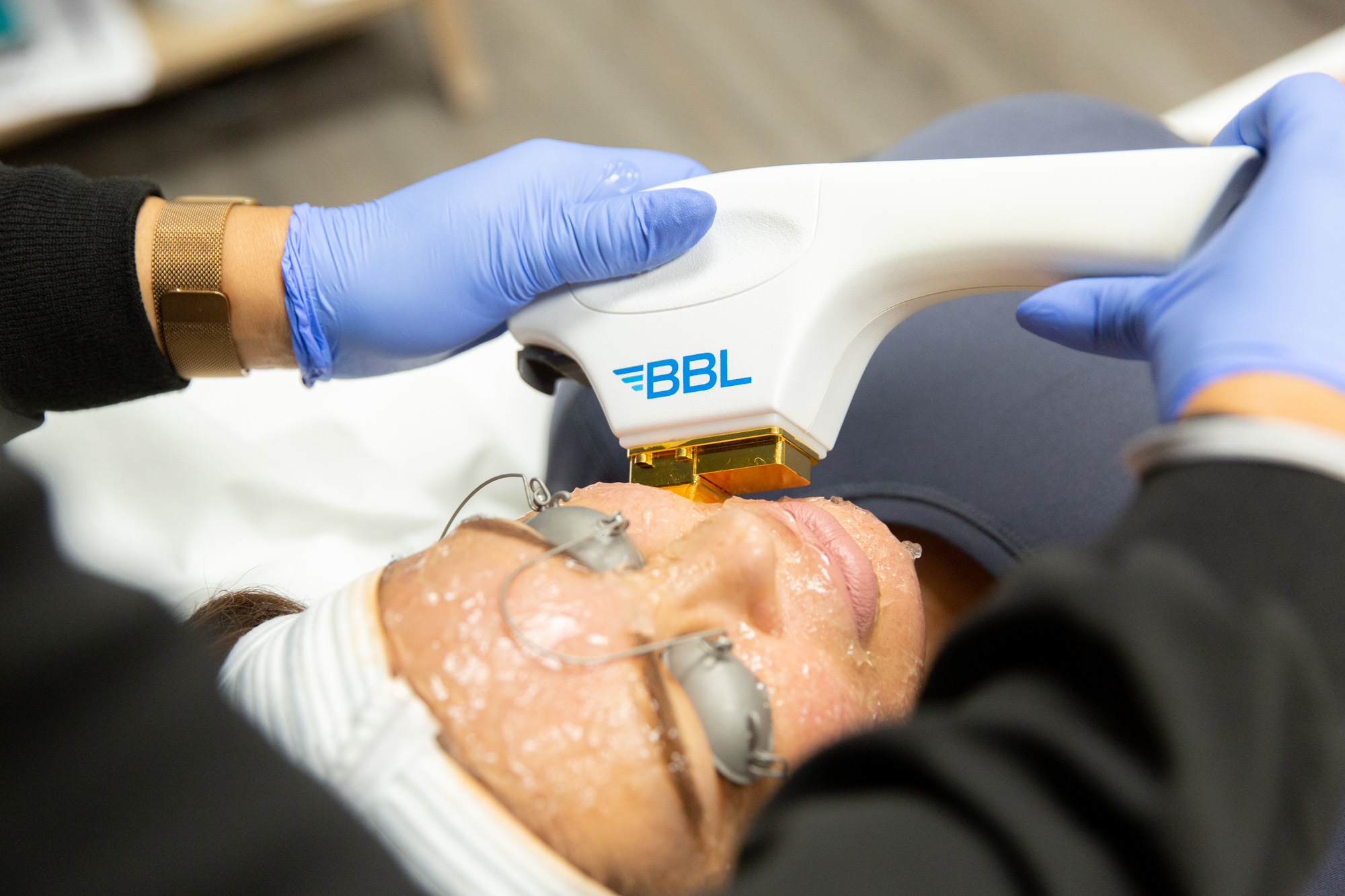 Close up taken from above of BBL Hero machine being applied to female client's jawline.