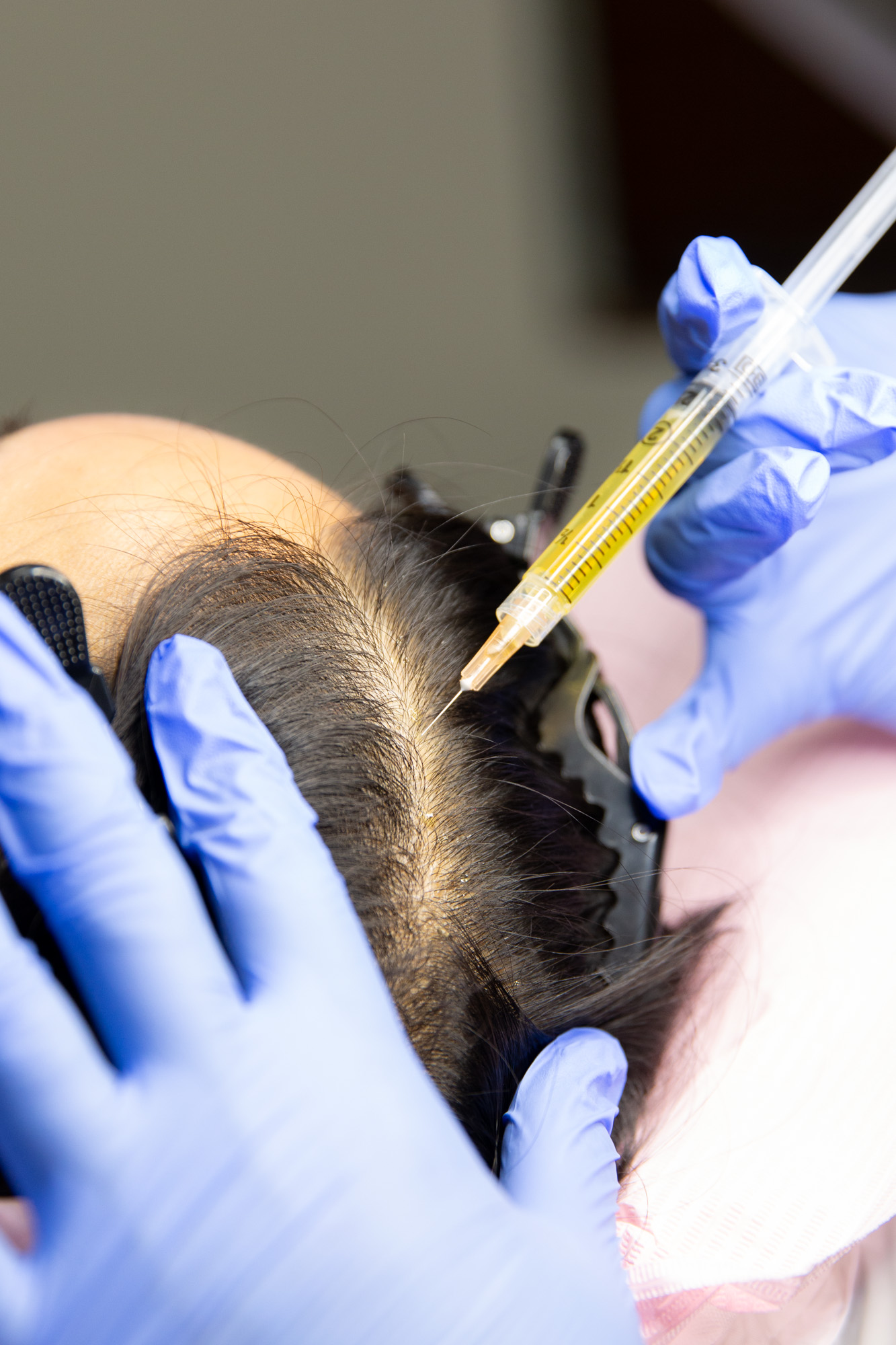 Marcos Medical provider injects PRP back into client's scalp at their part.