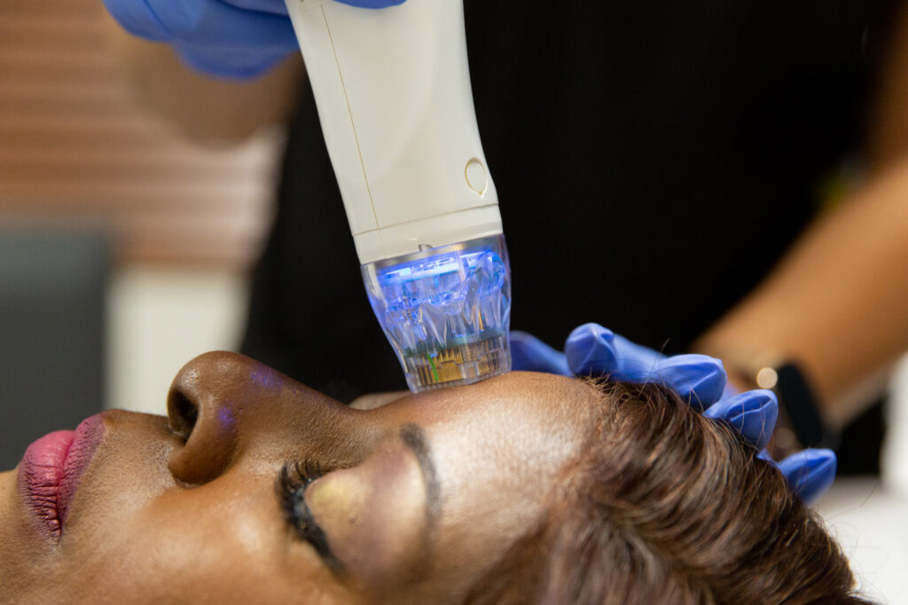 Close up of handheld microneedling tool being applied to patient's forehead.