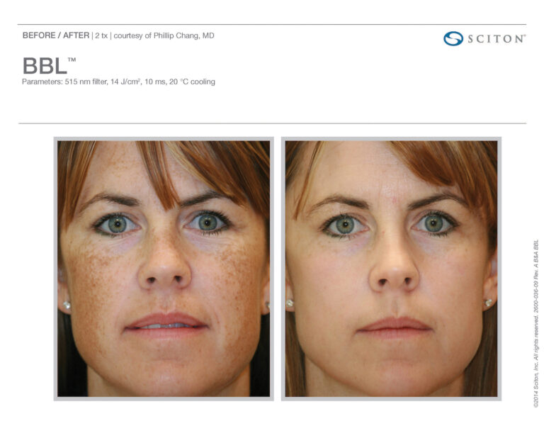 Side by side before and after images of woman's face with BBL treatment. Left image is before, right image is after - skin tone more even, freckles reduced. Before/after two treatments - courtesy of Phillip Chang, MD BBL trademarked. Parameters: 515 nm filter, 15 J/centimeters squared, 10 ms, 20 degrees Celsius cooling. Copyright 2014 Sciton, Inc. All rights reserved. 2600-036-09 Rev. A B and A BBL.