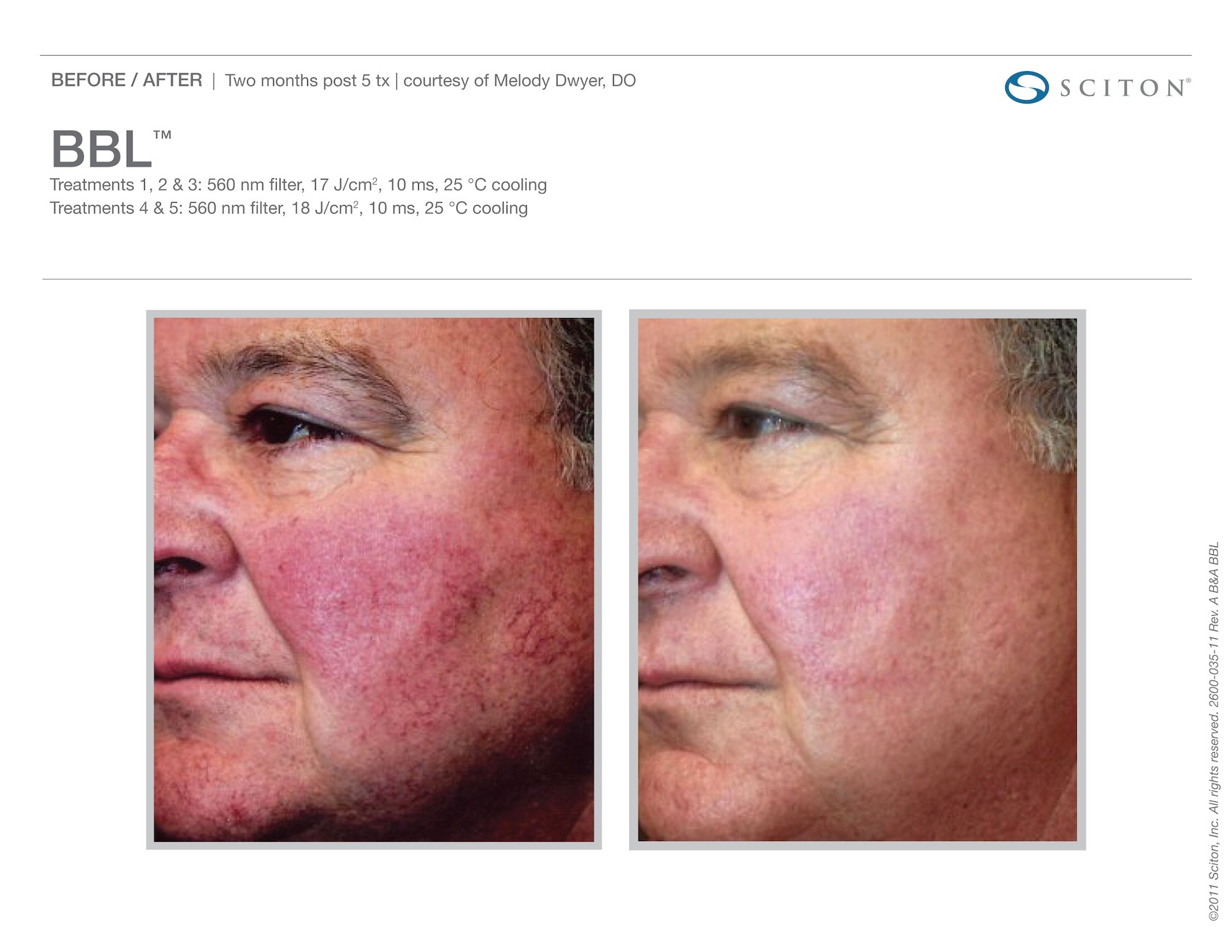 Side by side before and after images of close up of man's left side of face. Left image shows before, right image shows after BBL Hero treatment - redness in skin significantly decreased. Before/After - two months post 5 treatments - courtesy of Melody Dwyer, DO. BBL TM. Treatments 1, 2, and 3: 560 nm filter, 17 J/centimeters squared, 10 ms, 25 degrees Celsius cooling Treatments four and five: 560 nm filter, 18 J/centimeters squared, 10 ms, 25 degrees Celsius cooling. Copyright 2011 Sciton, Inc. All rights reserved. 2600-035-11 Rev. A B and A BBL.