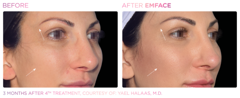 Side by side before and after images of close-up of woman's face. Arrows point to area below eyebrow and cheekbone on right side of face. Left image shows before, right image shows after Emface treatment, skin is brighter and firmer. Three months after fourth treatment, courtesy of Yael Halaas, MD.