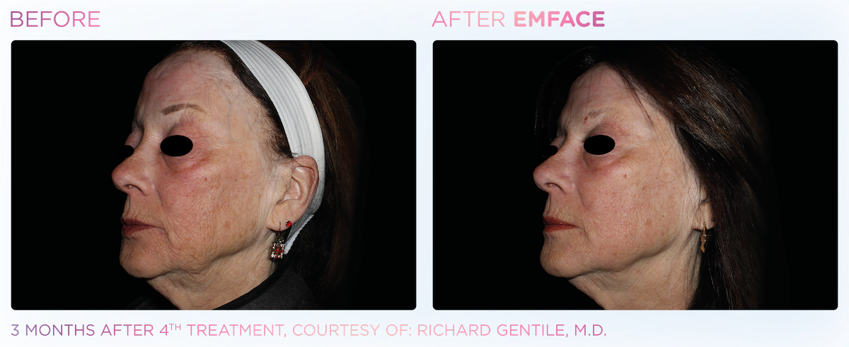 Side by side before and after images of woman with face angled to the right. Left image shows before, right image shows after Emface treatment - skin is clearer and more firm, less wrinkles. Three months after fourth treatment, courtesy of Richard Gentile, MD.