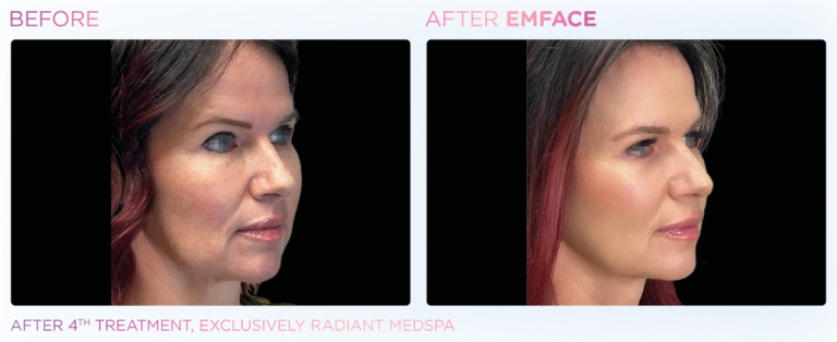 Side by side before and after images of woman's face angled to the left. Left image shows before, right image shows after Emface treatment - skin is brighter and tighter. After fourth treatment, Exclusively Radiant Med Spa.