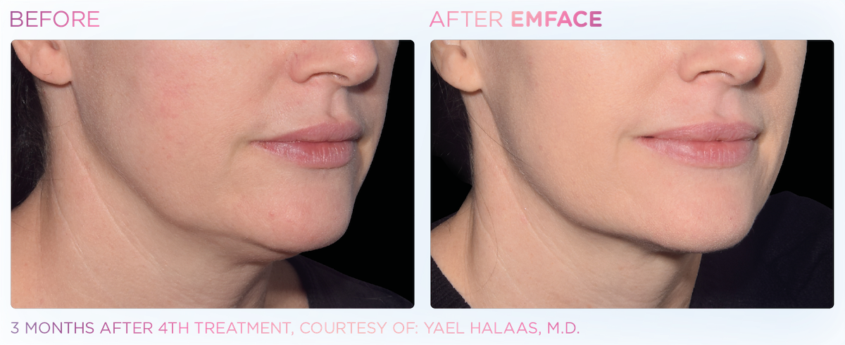 Side by side before and after images or woman's lower half of face. Left side shows before, right side shows after Emface treatment - jawline is more defined. Three months after fourth treatment, courtesy of Yael Halaas, MD.
