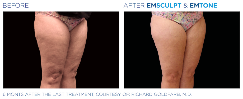 Side by Side Before and After Images for Emsculpt and Emtone Treatments on Woman's Waist to Upper Calf. Left side shows before - visible fat and loose skin. Right side shows after - skin is more firm and smooth. Six months after the last treatment, courtesy of Richard Goldfarb, MD.