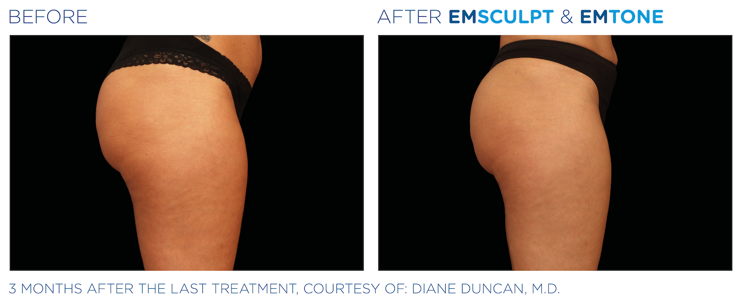 Side by side before and after images. Side view of woman's bottom and thigh. Left image is before - Right image is after Emsculpt and Emtone treatments, skin and body is visibly tighter. Three months after the last treatment, courtesy of Diane Duncan, MD.