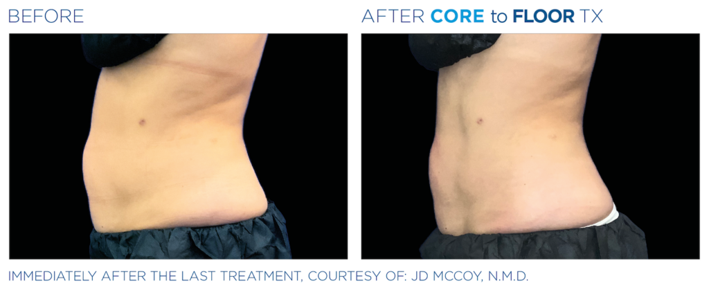 Side by side before and after images - side view of person's stomach. Left image shows before, right image shows after Emsculpt NEO Core to Floor TX treatment - stomach is tighter. Immediately after the last treatment, courtesy of JD McCoy, N.M.D.