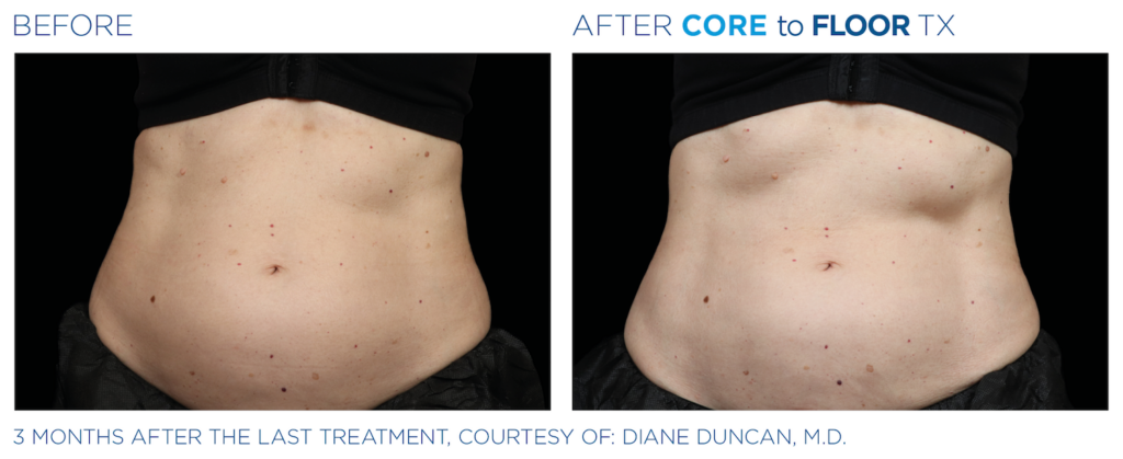 Side by side before and after images of person's stomach. Left side is before, right side is after Emsculpt NEO Core to Floor TX treatment - stomach is tighter. Three months after the last treatment, courtesy of Diane Duncan, MD.