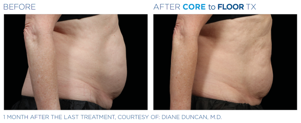 Side by side before and after images of side view of person's stomach. Left image is before, right side is after Emsculpt NEO Core to Floor TX treatment - stomach is tighter and does not sag. One month after the last treatment, courtesy of Diane Duncan, MD.