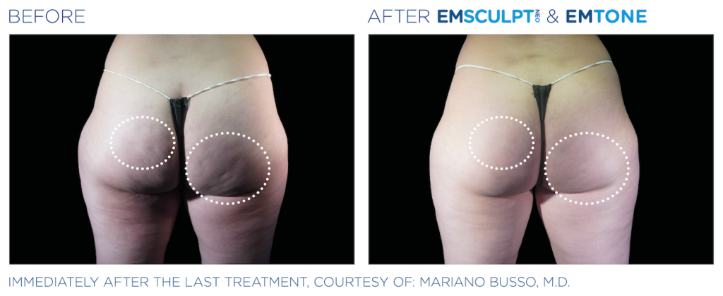 Side by side before and after images of woman's bottom. Areas of uneven skin from fat are circled twice in both images. Left side shows before, right side shows tighter, smooth skin after Emsculpt NEO and Emtone treatment. Immediately after the last treatment, courtesy of Mariano Busso, MD.