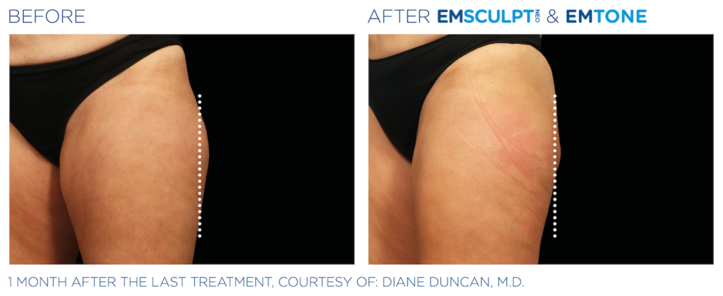 Side By Side Before and After Images of Emtone and EmSculpt NEO Treatments on Woman's Upper Outer Thigh. Left Image is Before, Thigh extends past hip. Right Image is After, thigh is in line with hip, fat reduced. One month after the last treatment, courtesy of Diane Duncan, MD