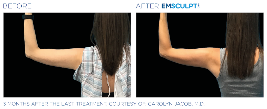 Side by side before and after images of woman's left arm, raised, flexed, and viewed from behind. Left image is before, right image is after Emsculpt NEO treatment and shows skin and muscle to be more firm. Three months after the last treatment, courtesy of Carolyn Jacob, MD.