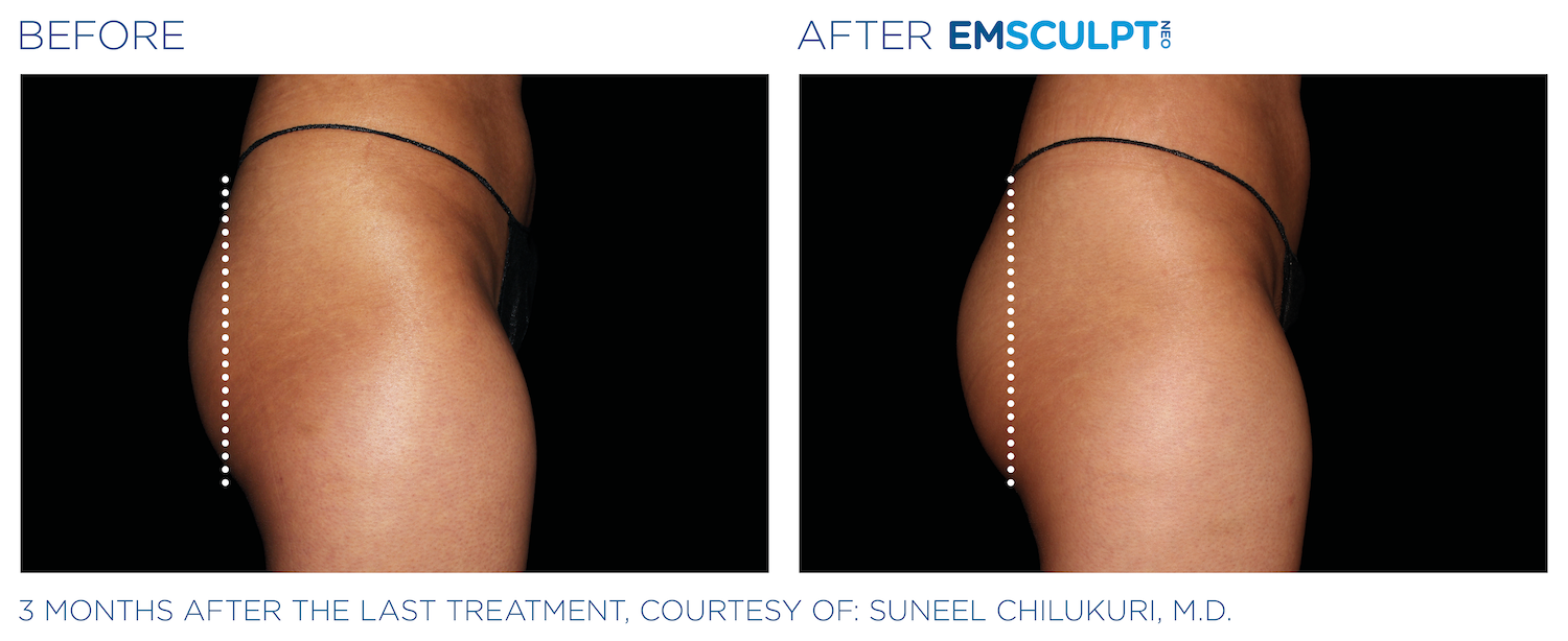 Side by side before and after images - side view of woman's bottom. Left image is before, with line drawn vertically towards edge of her bottom. Right image is after Emsculpt NEO treatment, with same line drawn vertically towards the edge of bottom - after photo shows the bottom as more full, extending further past the line. Three months after the last treatment, courtesy of Suneel Chilukuri, MD.