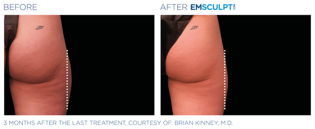 Side by sides images of before and after Emsculpt NEO treatment - images show right side of bottom and upper thigh. Left image shows before with line drawn vertically down thigh, right image shows after with line drawn vertically down the thigh - the thigh does not extend as far past the line in second photo. Three months after the last treatment, courtesy of Brian Kinney, MD.