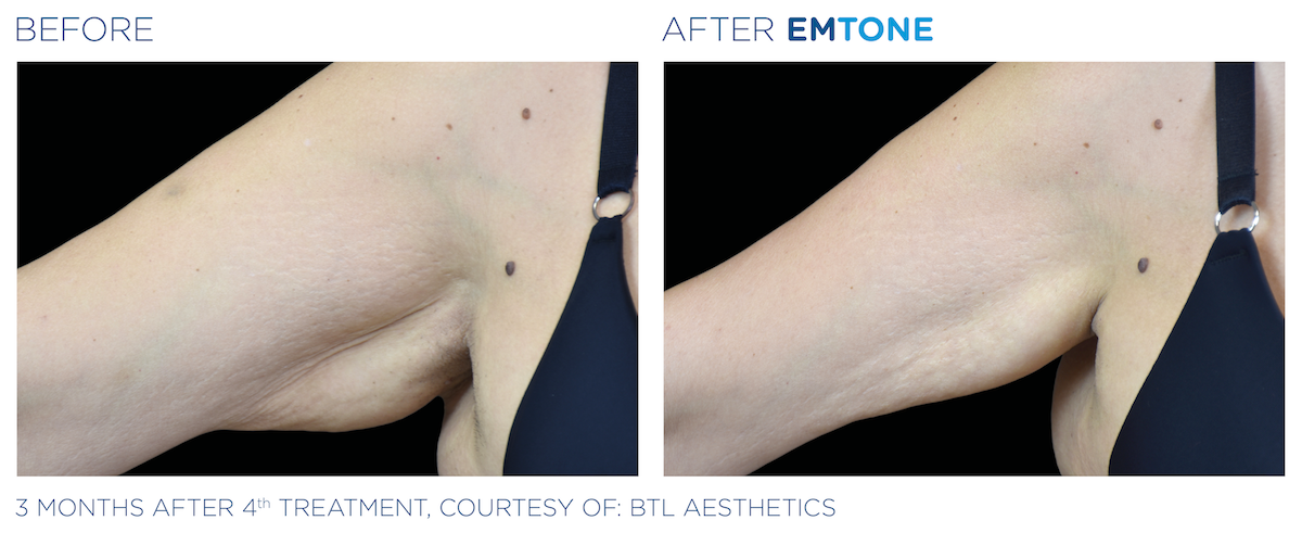 Side By Side Before and After Images of Emtone Treatment on Woman's Upper Underarm. Left side shows before - large skin flap hanging from upper arm. Right side shows after - skin is tighter and does not hang down as far. Three months after fourth treatment, courtesy of BTL Aesthetics