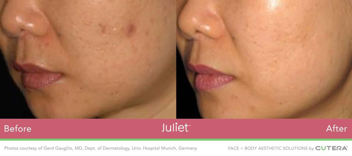 Side By Side Before and After Image of Woman's Left Lower Half of Face with Juliet Facial Treatment at Marcos Medical. Left Image shows acne scarring and deep pores. Right Image shows after - tighter skin, scars reduced. Photos courtesy of Gerd Gauglitz, MD, Dept. of Dermatology, Univ. Hospital Munich, Germany. Face and Body Solutions by Cutera.
