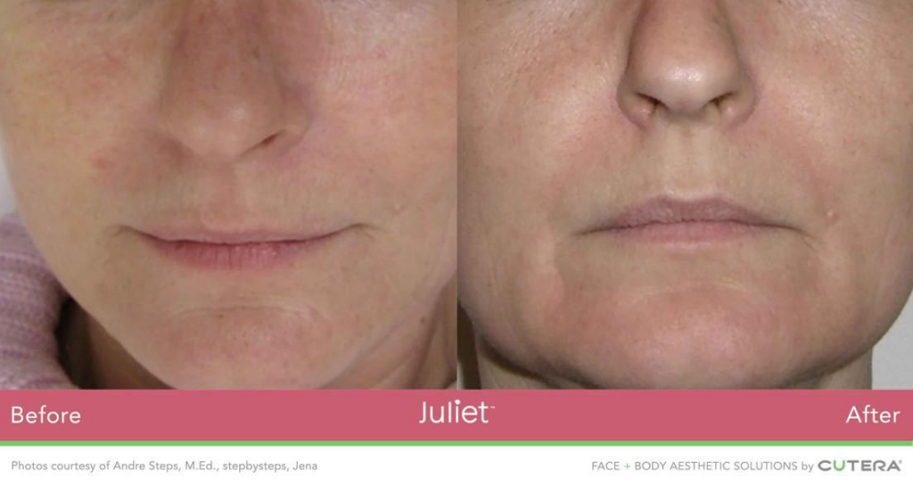 Side By Side Before and After Image of Woman's Lower Half of Face - Shows Impact of Juliet Facial Treatment at Marcos Medical. Left Image is Before - Skin is Loose with Wrinkles. Right is After - Skin is More Firm and Wrinkles are Reduced. Photos Courtesy of Andre Steps, M.Ed., stepsbysteps, Jena. Face and Body Aesthetic Solutions by Cutera.