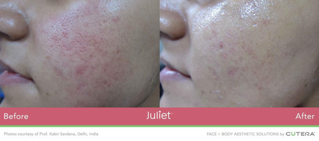 Side By Side Before and After Image of Woman's Cheek. Left Image is Before - Skin is Inflamed with Acne Scars. Right Image is After - Skin is clearer and scars are reduced. Treatment is Juliet Facial at Marcos Medical. Photos courtesy of Professor Kabir Sardana, Delhi, India. Face and Body Aesthetic Solutions by Cutera.