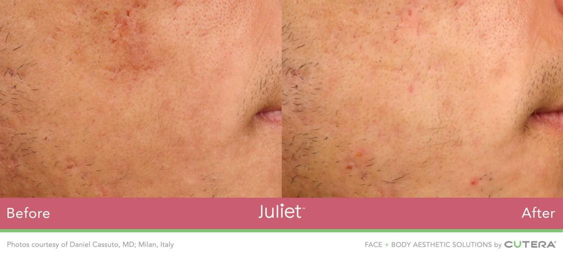 Side By Side Image of Before and After of Skin on Man's Cheek. Left Image is Before, with More Acne - Right Image is After, Skin is Brighter and Clearer. Acne Reduced from Juliet Facial Treatment at Marcos Medical. Photos courtesy of Daniel Cassuto, MD; Milan, Italy. Face and Body Aesthetic Solutions by Cutera.