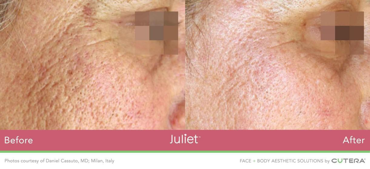 Side By Side Before and After Image of Woman's Skin Near Eye and Upper Cheek Area, Tighter and Brighter After Juliet Facial Treatment at Marcos Medical. Photos courtesy of Daniel Cossuto, MD; Milan, Italy. Face and Body Aesthetic Solutions by Cutera.