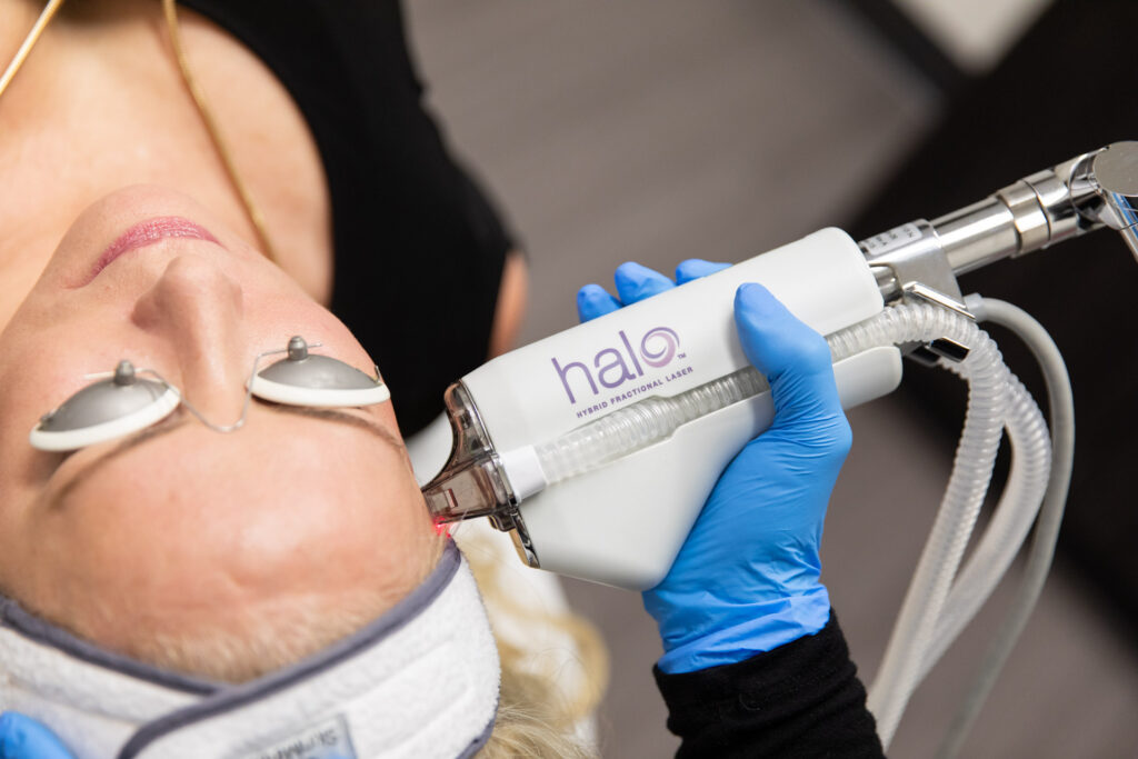 A woman's face with goggles on as a provider's gloved hand applies Halo Laser Skin Resurfacing in San Antonio